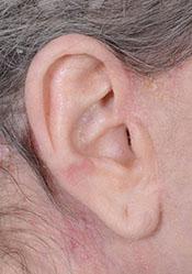 ear distortion after