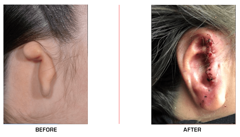 Ear Reconstruction before after case11