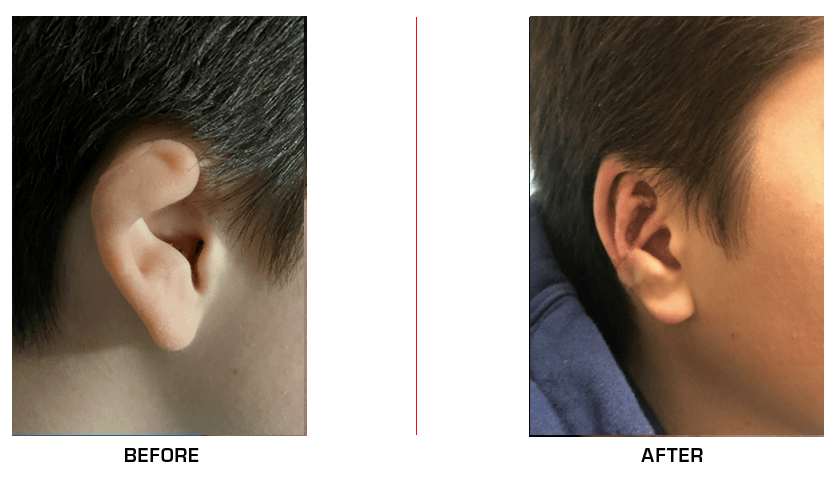 Ear Reconstruction before after case12