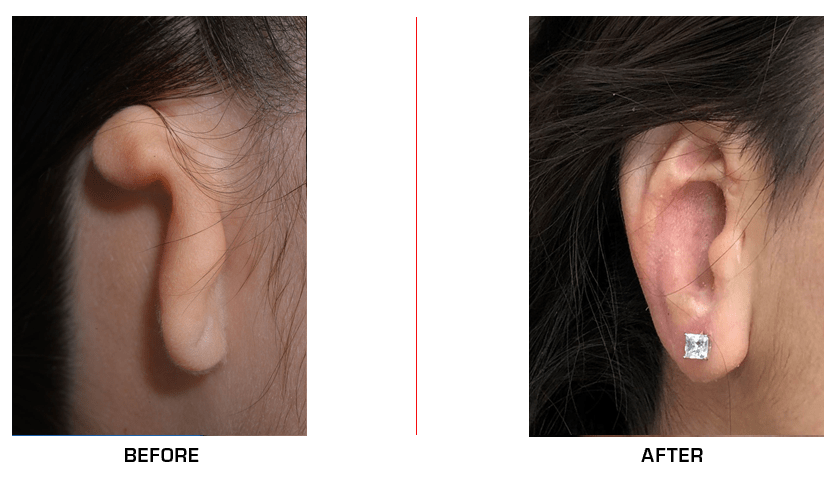 Ear Reconstruction before after case13