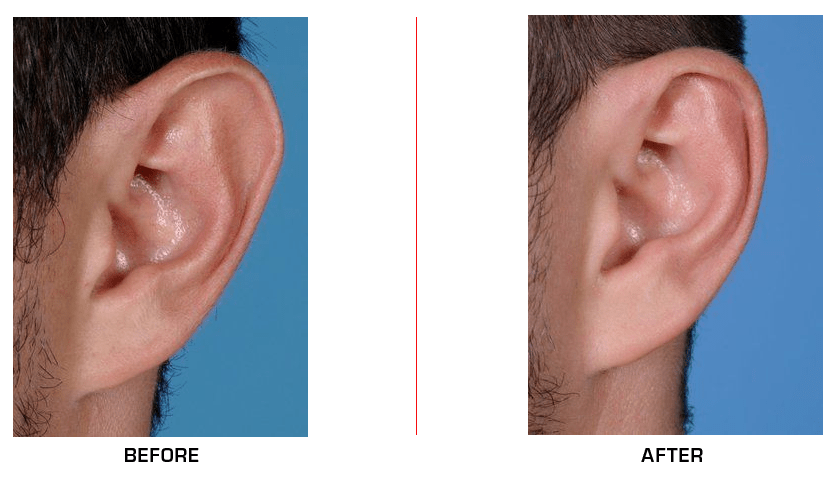 Otoplasty Ear Reduction before after case1