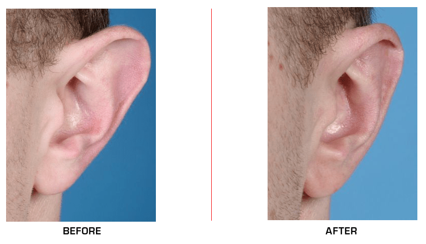Otoplasty Ear Reduction before after case3