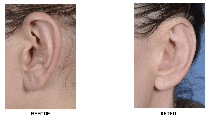 Otoplasty Ear Reduction before after case4