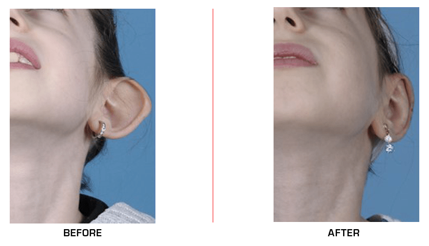 Otoplasty Ear Reduction before after case5