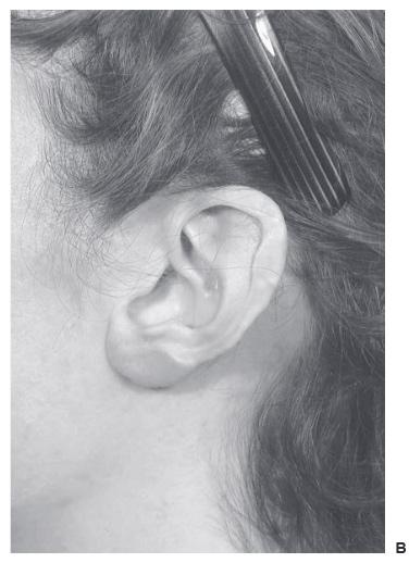 Earlobe reconstruction 2