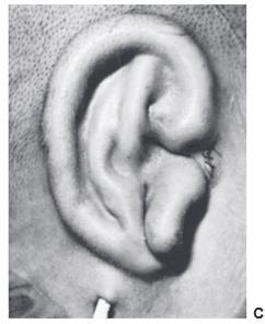 Insertion of the ear framework 3