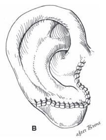 Rotation of lobule 1