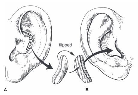 Construction of tragus 1