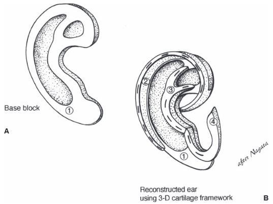 Fabrication of ear framework from rib cartilage