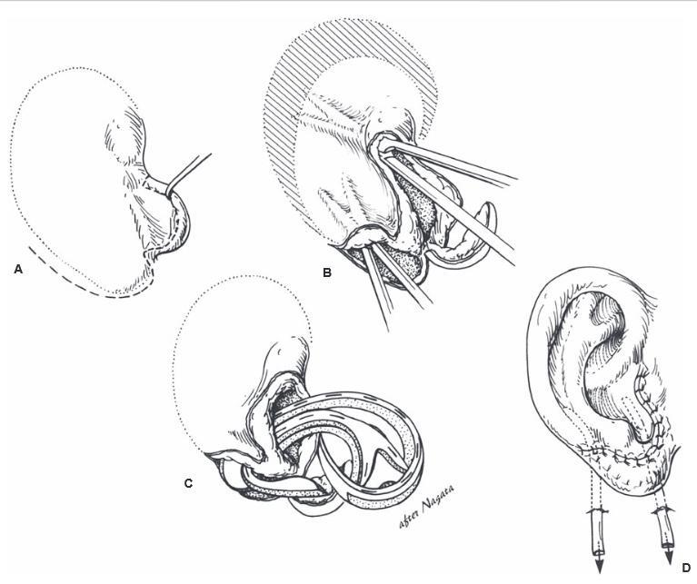 Insertion of the cartilage framework