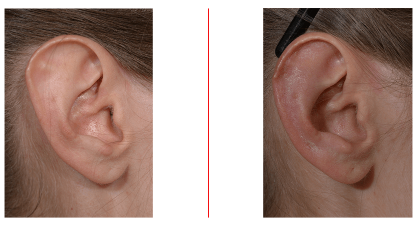Otoplasty Correction of Stahl's Ear